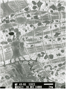 Studies of heart ultrastructure in various diseases by prof A. Fidziańska-Dolot: dilated cardiomyopathy - 49/08