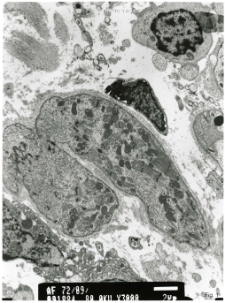 Studies of heart ultrastructure in various diseases by prof A. Fidziańska-Dolot: myocarditis - 72/09