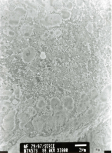 Studies of heart ultrastructure in various diseases by prof A. Fidziańska-Dolot: dilated cardiomyopathy - 79/07