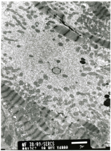 Studies of heart ultrastructure in various diseases by prof A. Fidziańska-Dolot: dilated cardiomyopathy - 38/09