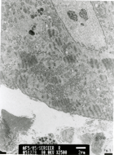 Studies of heart ultrastructure in various diseases by prof A. Fidziańska-Dolot: dilated cardiomyopathy - 5/05