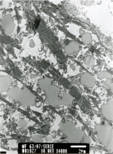 Studies of heart ultrastructure in various diseass by prof A. Fidziańska-Dolot: left ventricular non-compaction cardiomyopathy (LVNC) - 63/07