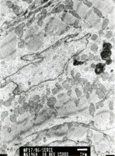 Studies of heart ultrastructure in various diseases by prof A. Fidziańska-Dolot: myocarditis - 17/06