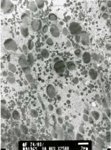 Studies of heart ultrastructure in various diseass by prof A. Fidziańska-Dolot: cardiomyopathy - 74/09